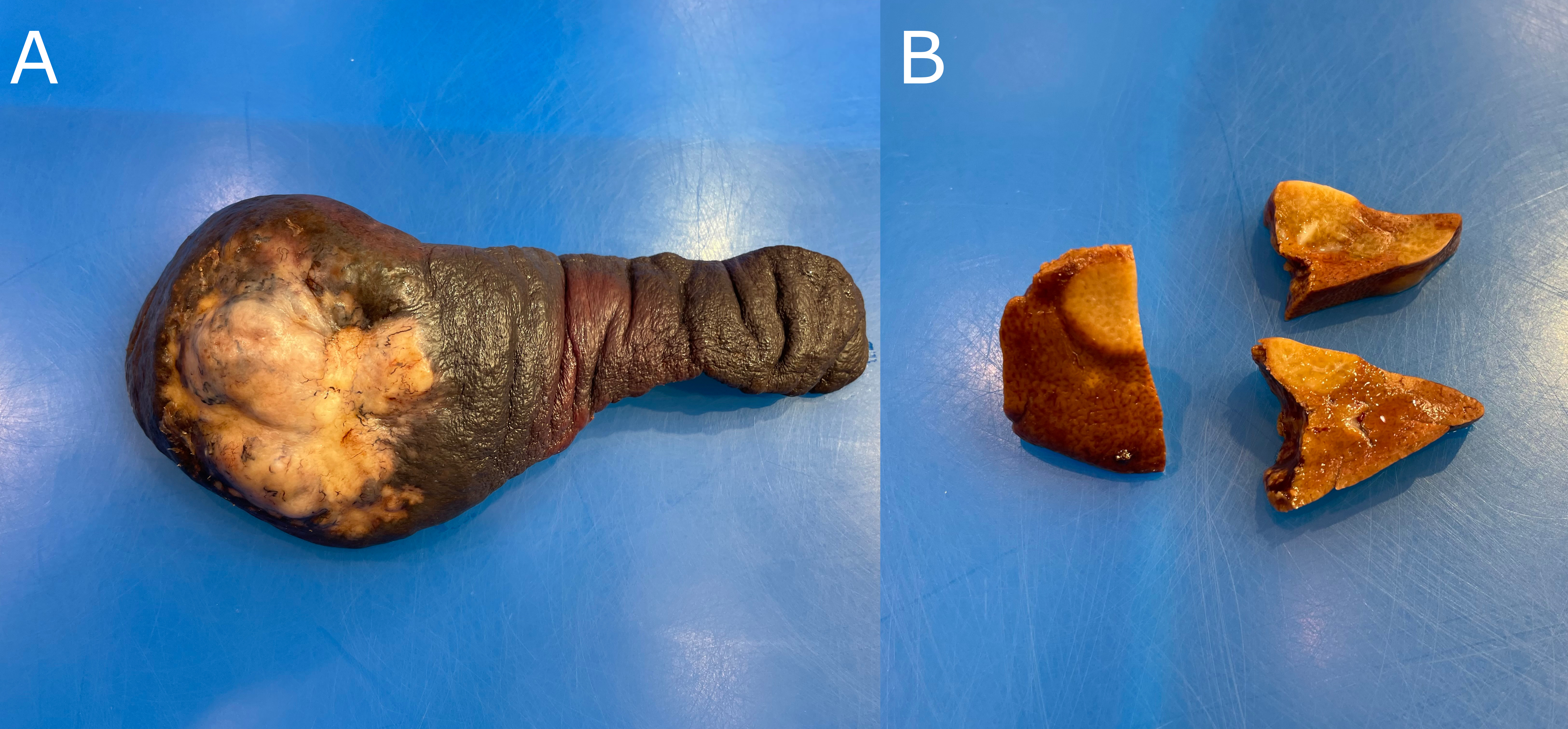 A) A canine spleen with a single, raised, firm, white, multilobular,  poorly demarcated mass. B) A mass of similar description is present within multiple samples of liver (suggestive of metastasis).