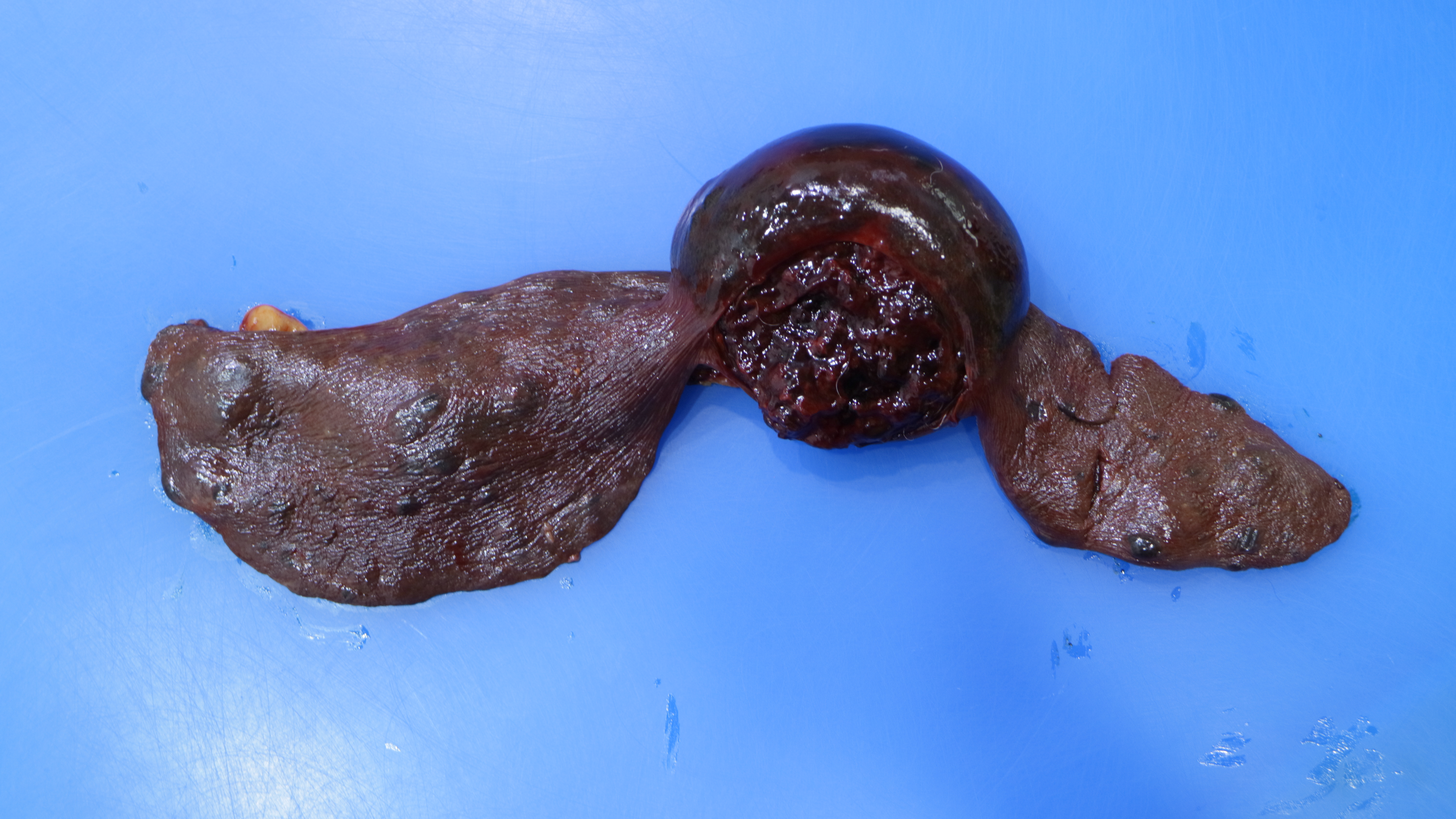 A large, red, friable, partially necrotic mass is present at the approximate midpoint of the spleen. Multiple other variably sized, red, raised masses are present randomly throughout the remaining parenchyma.