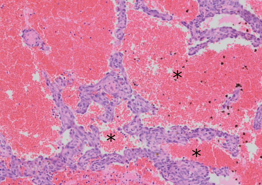 Hemangiosarcomas are composed of channels (marked with *) filled with blood and lined by neoplastic endothelial cells. Note the thin walls of these channels: these masses are fragile and rupture easily, leading to hemorrhage both within the mass and potentially into the abdomen.