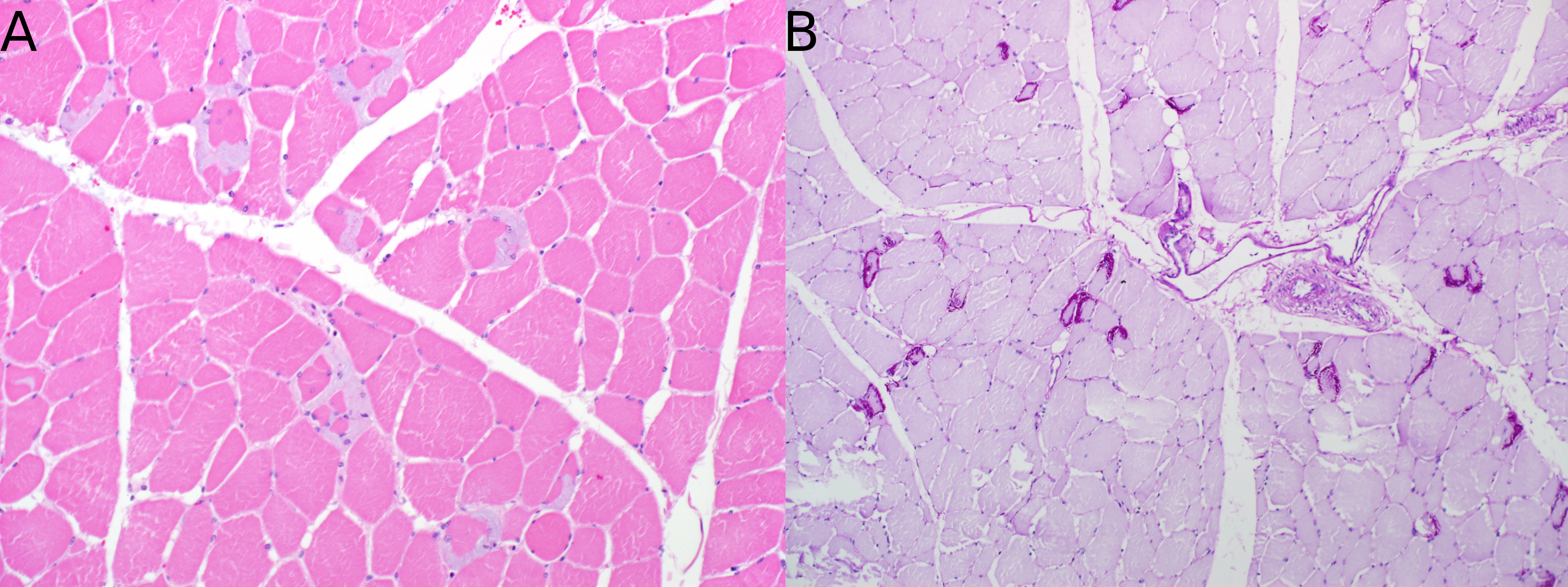 Photomicrograph of muscle from a horse with PSSM. A) Multiple myofibers show distinct amphophilic material, particularly along the periphery of the myofiber. H&E B) The material stains positive with PAS (bright magenta). PAS. 