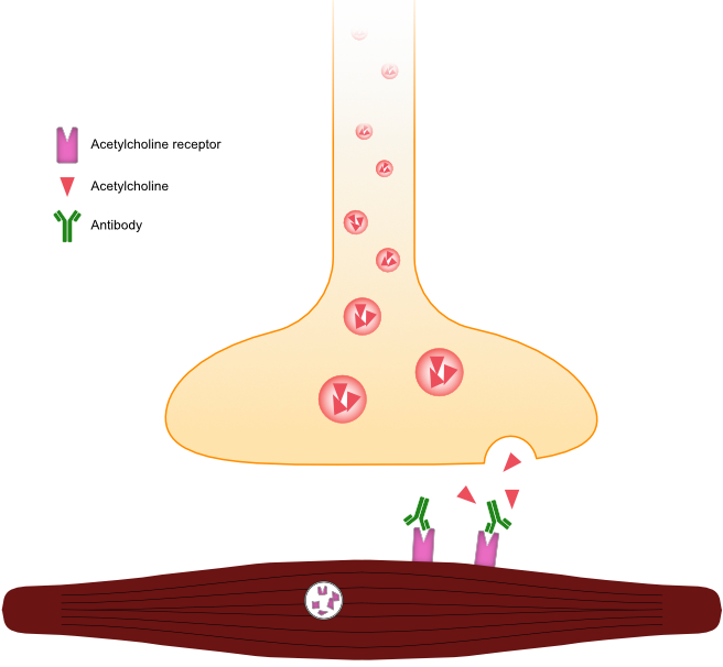 Illustration of a motor end plate affected by acquired myasthenia gravis. Note the immunoglobulin binding to the acetylcholine receptor, preventing the binding of acetylcholine, and also leading to endocytosis and decreased receptor density.