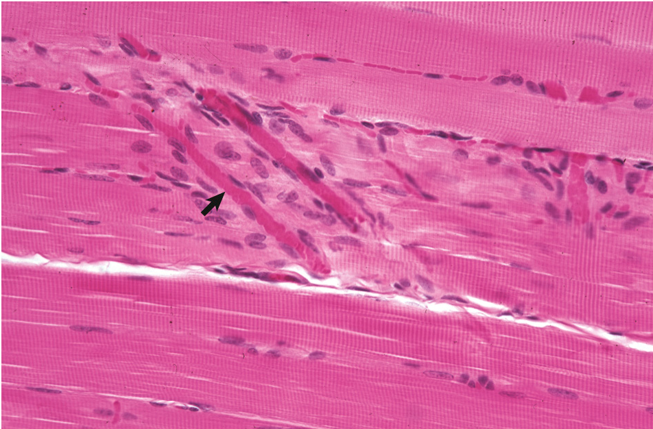 Normal skeletal muscle demonstrating striations. The arrow indicates a small capillary. Figure from Zachary and McGavin.