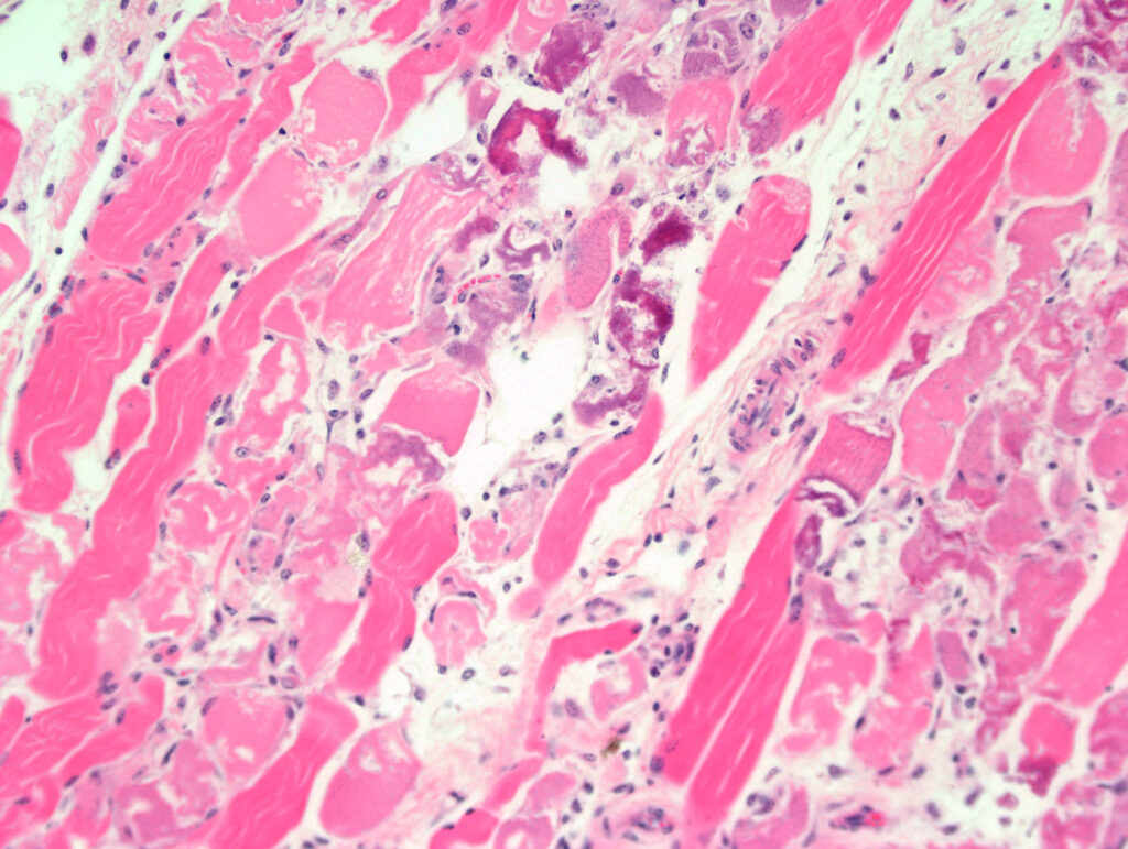 Severe myonecrosis